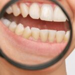 przebarwienia na zębach