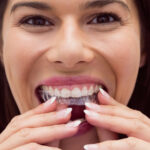 nakładki na zęby